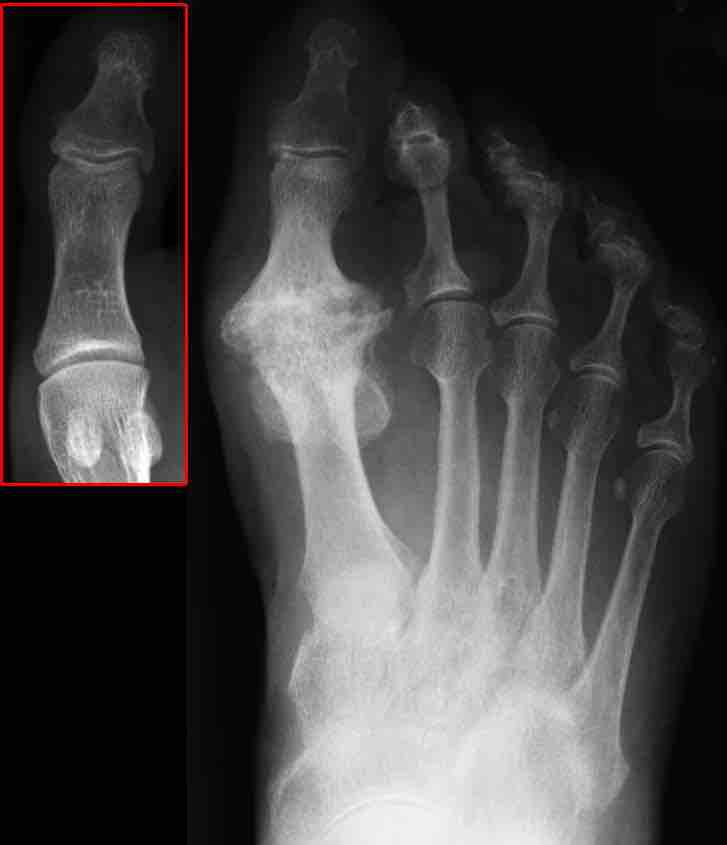 Osteoarthritis