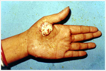 Cáncer de piel en la palma