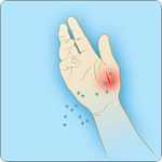 	illustration of hand with anthrax spores entering a cut