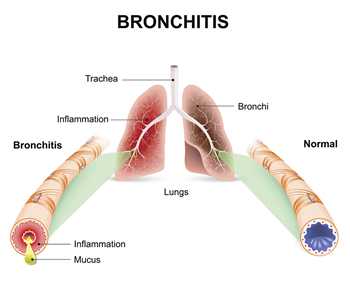 Bronchitis occurs when the airways of the lungs swell and produce mucus. That’s what makes you cough