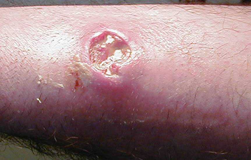 Photograph depicted a cutaneous abscess, caused by MRSA