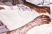 Name that rash: smallpox on arms of patient.