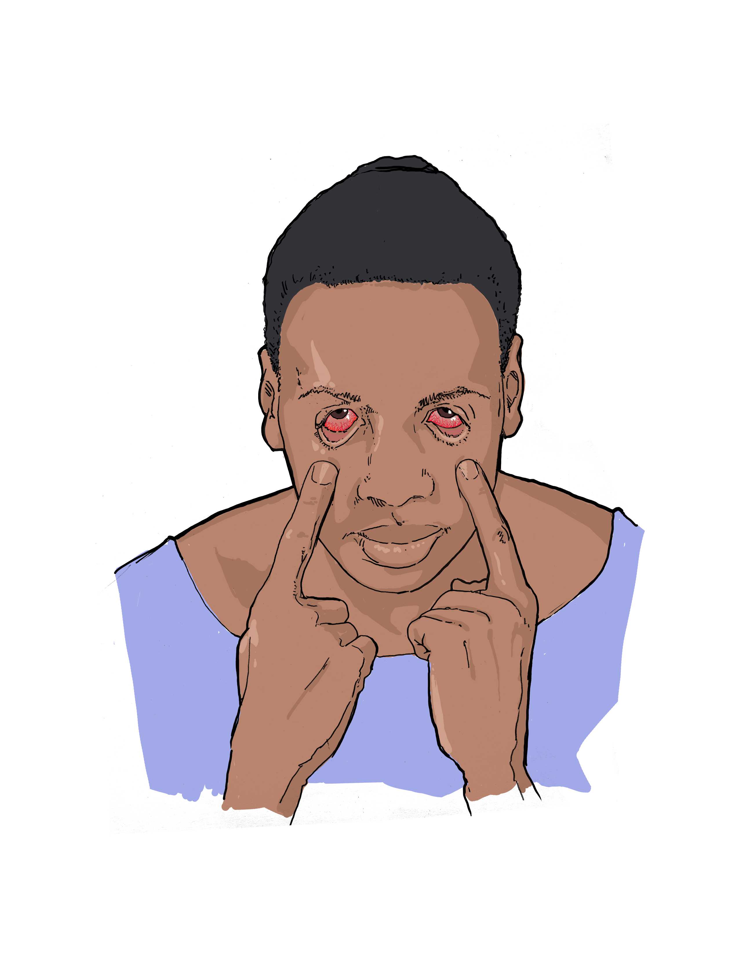 Symptoms: Red eyes