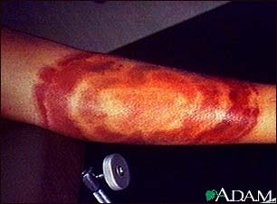 Lyme disease, erythema chronicum migrans Lyme disease, erythema chronicum migrans