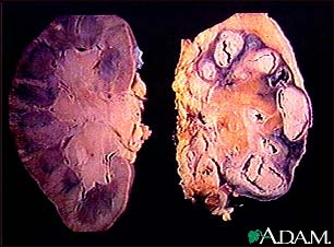 Tuberculosis in the kidney Tuberculosis in the kidney