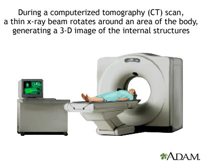 CT scan CT scan