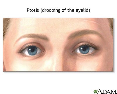 Ptosis, drooping of the eyelid Ptosis, drooping of the eyelid
