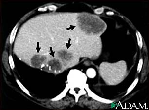 Liver metastases, CT scan Liver metastases, CT scan