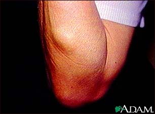 Lipoma - arm Lipoma - arm