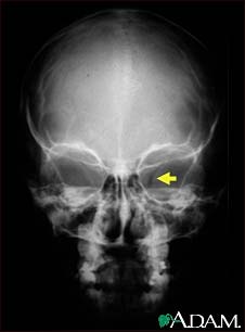 Neurofibromatosis I, enlarged optic foramen Neurofibromatosis I, enlarged optic foramen