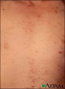 Chickenpox - lesions on the chest Chickenpox - lesions on the chest