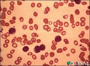 Chronic lymphocytic leukemia - microscopic view Chronic lymphocytic leukemia - microscopic view