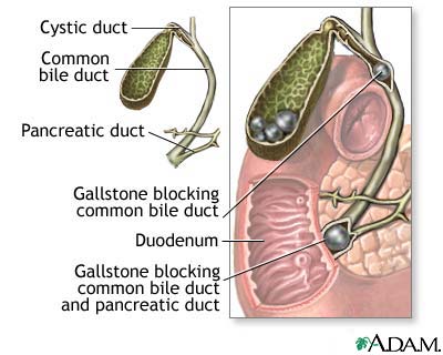 Choledocholithiasis Choledocholithiasis