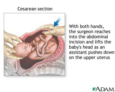 Cesarean section Cesarean section