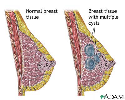 Fibrocystic breast disease Fibrocystic breast disease