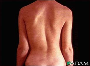 Scoliosis Scoliosis