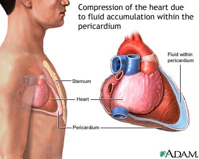 Cardiac tamponade Cardiac tamponade