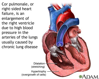 Cor pulmonale Cor pulmonale