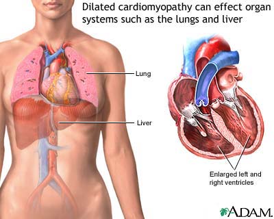 Dilated cardiomyopathy Dilated cardiomyopathy