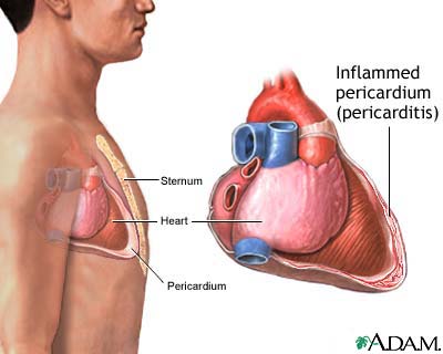 Pericarditis Pericarditis