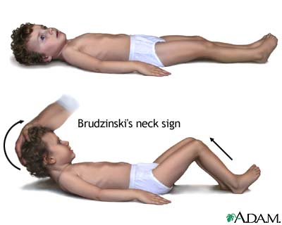 Brudzinski's sign of meningitis Brudzinski's sign of meningitis