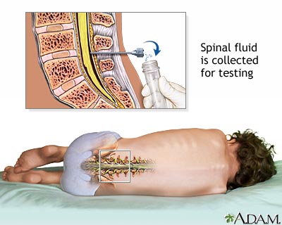 Lumbar puncture (spinal tap) Lumbar puncture (spinal tap)