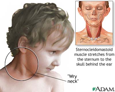 Torticollis (wry neck) Torticollis (wry neck)