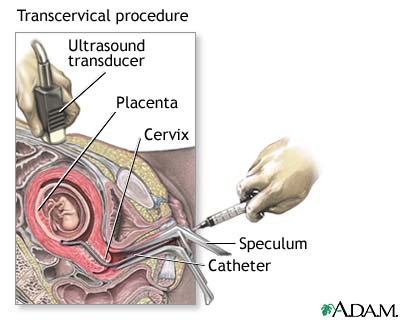 Procedure, part 2 - transcervical