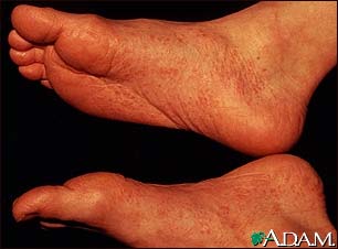 Reiter's syndrome - view of the feet Reiter's syndrome - view of the feet