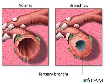 Bronchitis and Normal Condition in Tertiary Bronchus Bronchitis and Normal Condition in Tertiary Bronchus