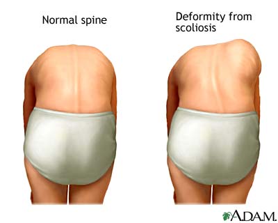 Forward bend test Forward bend test