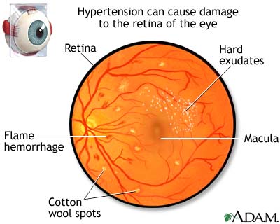 Hypertensive retinopathy Hypertensive retinopathy