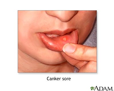Canker sore Canker sore