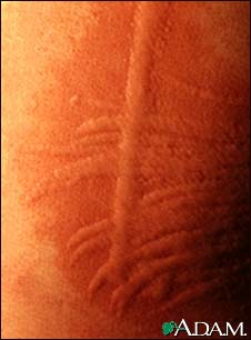 Dermatographism - close-up Dermatographism - close-up