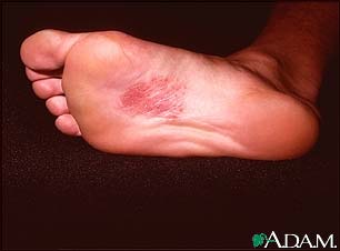 Dermatitis, nickel on the sole Dermatitis, nickel on the sole