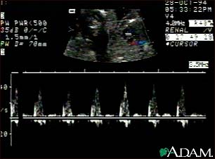 Ultrasound, normal fetus - heartbeat Ultrasound, normal fetus - heartbeat