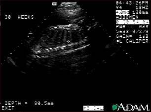 Ultrasound, normal fetus - spine and ribs Ultrasound, normal fetus - spine and ribs