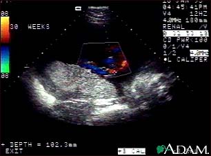 Ultrasound, color - normal umbilical cord Ultrasound, color - normal umbilical cord