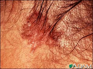 Skin cancer, basal cell carcinoma - pigmented Skin cancer, basal cell carcinoma - pigmented