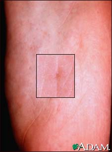 Basal cell nevus syndrome - plantar pits Basal cell nevus syndrome - plantar pits