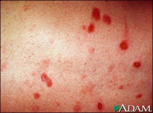 Erythema multiforme on the leg Erythema multiforme on the leg