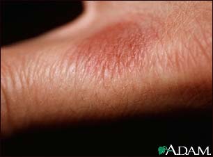 Fixed drug eruption Fixed drug eruption