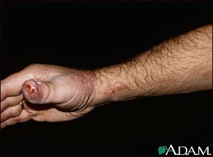 Sporotrichosis on the hand and arm Sporotrichosis on the hand and arm