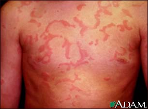 Hives (urticaria) on the chest Hives (urticaria) on the chest