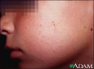 Keratosis pilaris on the cheek Keratosis pilaris on the cheek