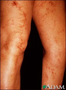 Livedo reticularis on the legs Livedo reticularis on the legs