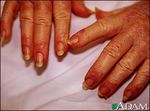 Paronychia, candidial