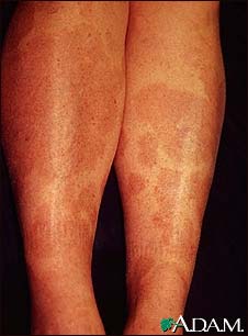 Granuloma, annulare on the legs Granuloma, annulare on the legs