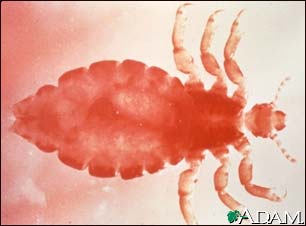 Head louse - female Head louse - female