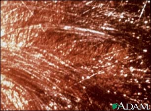 Head louse infestation - scalp Head louse infestation - scalp